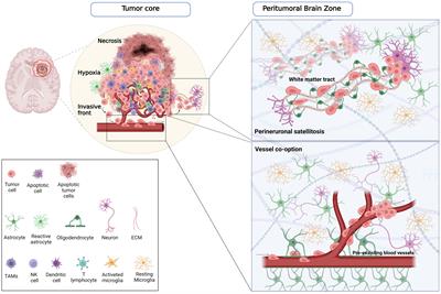 Peritumoral brain zone in glioblastoma: biological, clinical and mechanical features